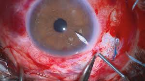 Glaucoma Surgery: Success Rates and Key Considerations