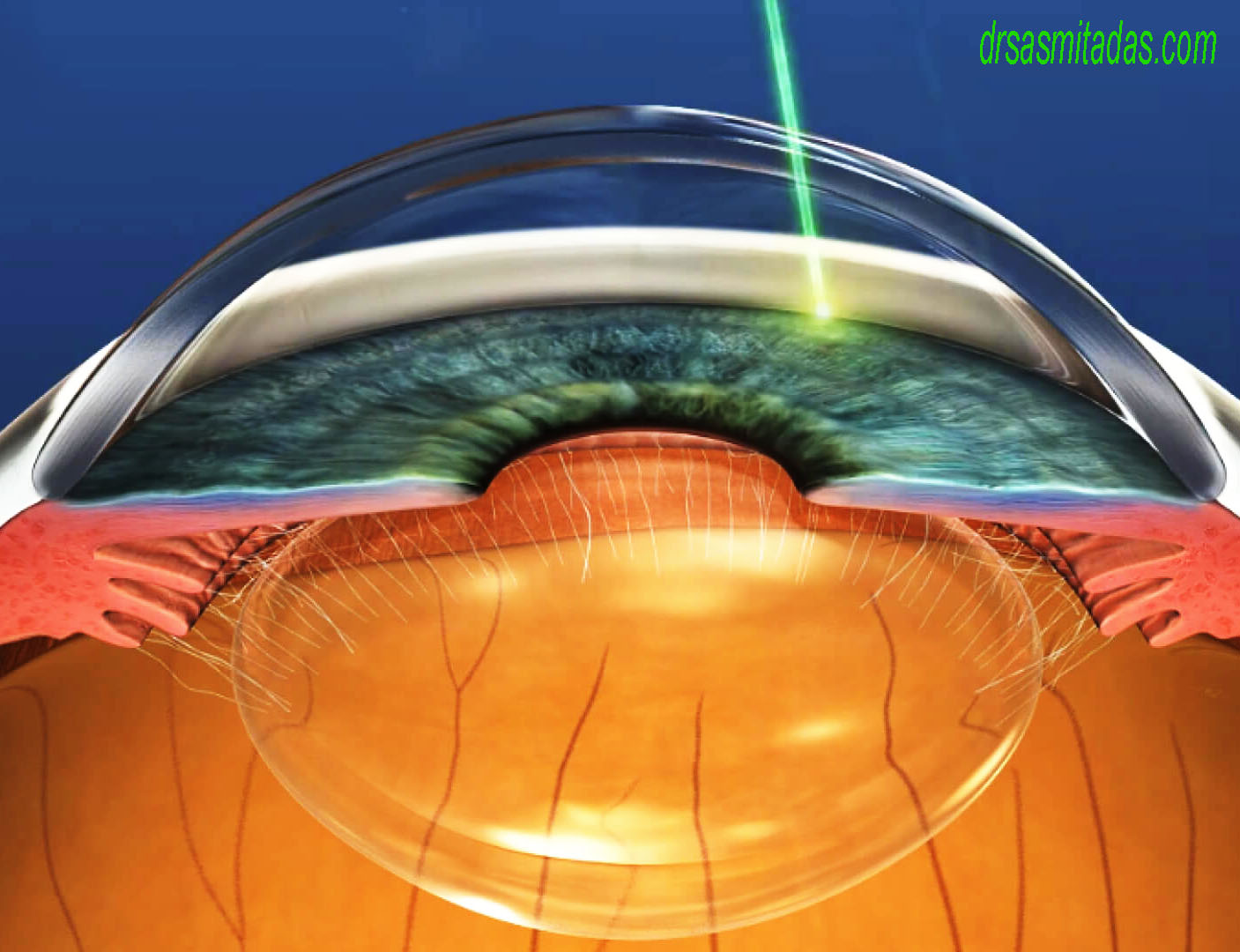 Glaucoma Laser Treatment: A Safe and Effective Option to Control Eye Pressure